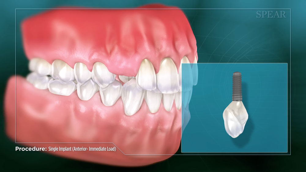 single implant