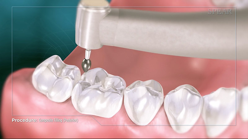 teeth in a day